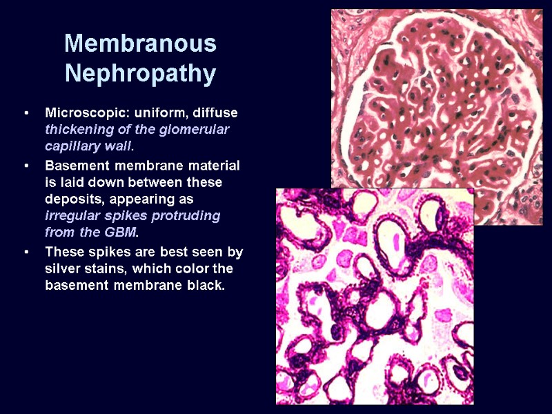 Membranous Nephropathy Microscopic: uniform, diffuse thickening of the glomerular capillary wall.  Basement membrane
